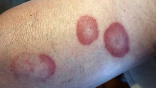 Granulomatosis Wegener dengan Antineutrophil Cytoplasmic Antibodies (ANCA) Negatif pada Laki-laki Usia 38 Tahun