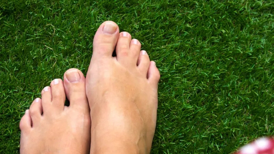 Terapi Oral dan Tetes Mata Topikal pada Green Nail Syndrome