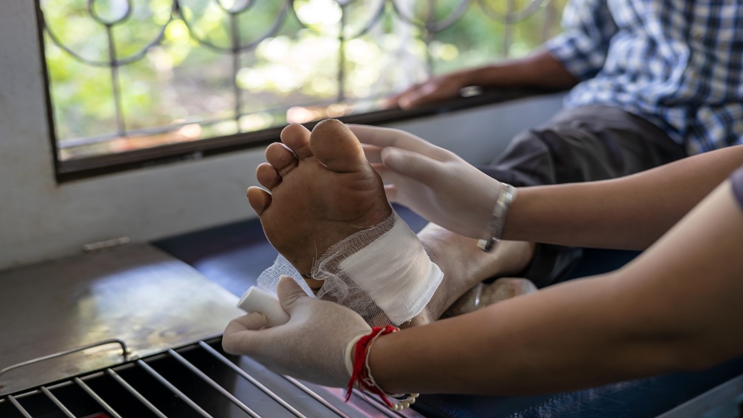 Terapi Ulkus Diabetikum Menggunakan Platelet Rich Plasma Terapi Ulkus Diabetikum Menggunakan Platelet Rich Plasma