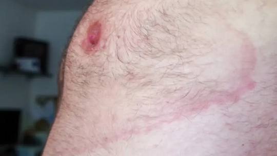 Familial Erythema Annulare Centrifugum pada Anak Berusia 9 Tahun Familial Erythema Annulare Centrifugum pada Anak Berusia 9 Tahun