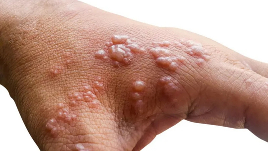 Tata Laksana Herpes Zoster