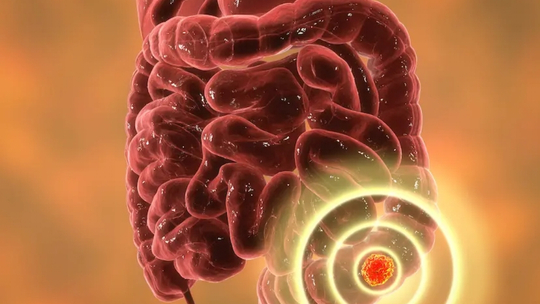 Manajemen Kanker Kolorektal Manajemen Kanker Kolorektal