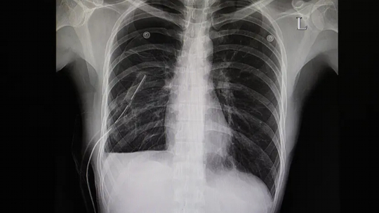 Pneumothorax Spontan pada Pasien Penyakit Paru Obstruktif Kronis