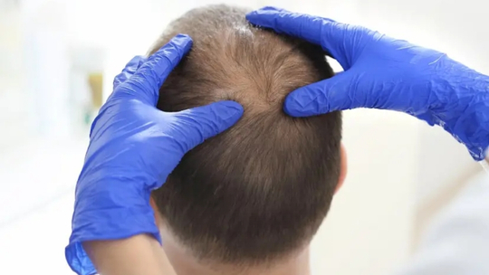 Pendekatan Diagnosis dan Tata Laksana Alopesia Androgenetik