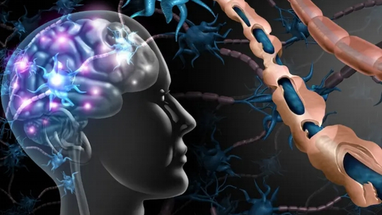 Peran Terapi Intravenous Immunoglobulin (IVIG) pada Pasien Multiple Sclerosis