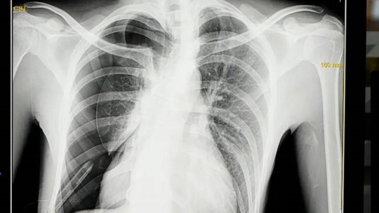 Pneumotoraks Spontan Sekunder akibat Tuberkulosis Paru Pneumotoraks Spontan Sekunder akibat Tuberkulosis Paru