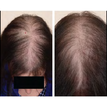 Pola AAG Pada Wanita