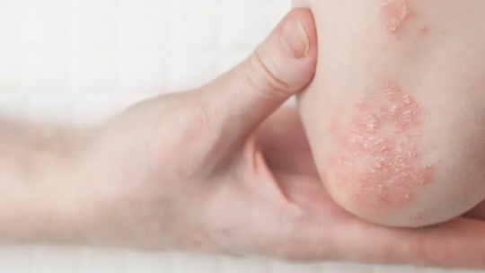 Insidensi dan Profil Penyakit Psoriasis di RS Martha Friska Multatuli Medan Periode Januari-Desember 2022