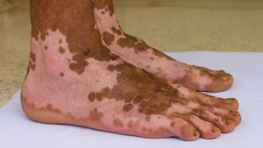 Terapi Zink Oral pada Vitiligo