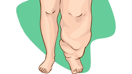 Lymphedema: Diagnosis dan Terapi