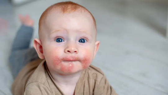 Laporan Kasus Acrodermatitis Enteropathica pada Anak 5 Tahun dengan Level Zink Serum Normal