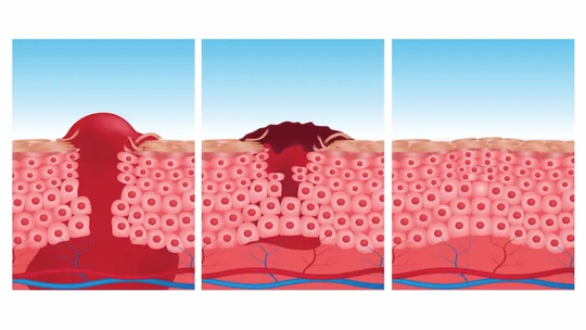 Efek Terapi Gel Lidah Buaya (Aloe Vera) dalam Penyembuhan Luka