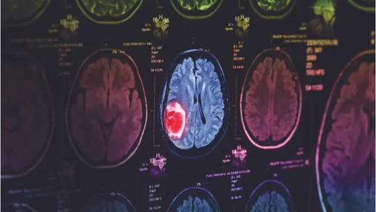 Diagnosis dan Manajemen Tumor Hipofisis