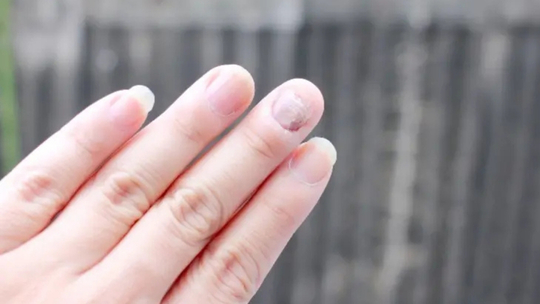 Elektrodesikasi dan Kuretase Tumor Koenen pada Tuberous Sclerosis Complex