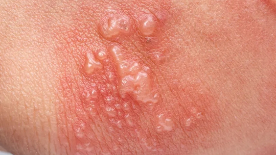 Profil Pemphigus Vulgaris di Instalasi Rawat Inap RSUD Dr. Moewardi Surakarta Periode Januari 2014-Desember 2019